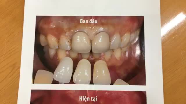 Lắp răng sứ mới cho bác Tuyết.