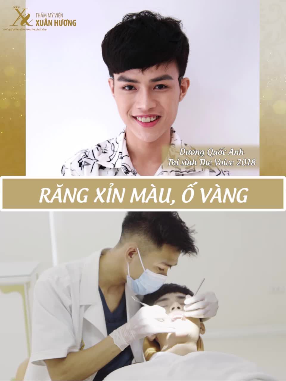 RĂNG SỨ THẨM MỸ CÓ PHẢI LÀ LỰA CHỌN DUY NHẤT CHO NỤ CƯỜI TỎA SÁNG?