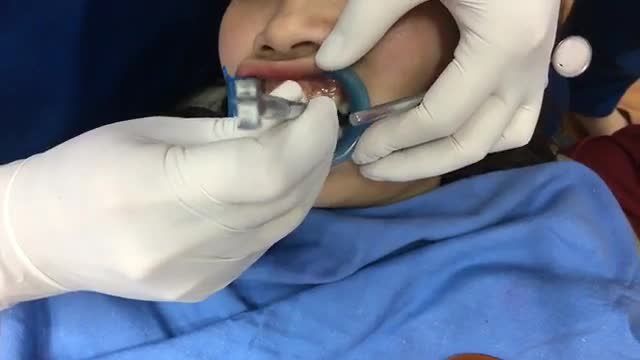 Gắn mắc cài hàm trên cho bạn Ngân tại Nha Khoa Thùy Anh.