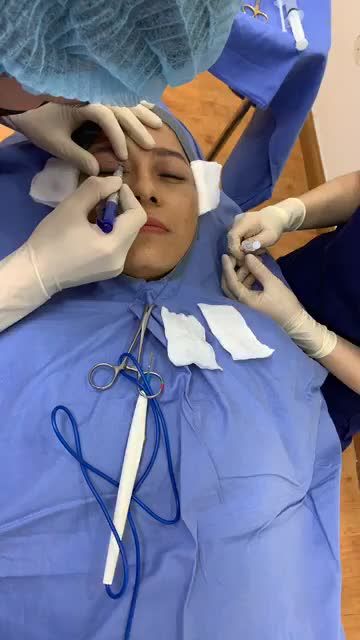 Nâng cung mày như thế nào mới đẹp Cùng xem bác sĩ tiến hành phân tích đo vẽ cho khách hàng
