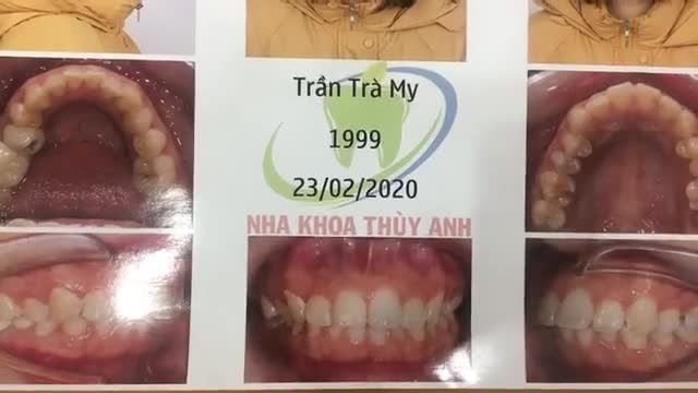 Gắn mắc cài cho bạn My tại Nha Khoa Thuỳ Anh.