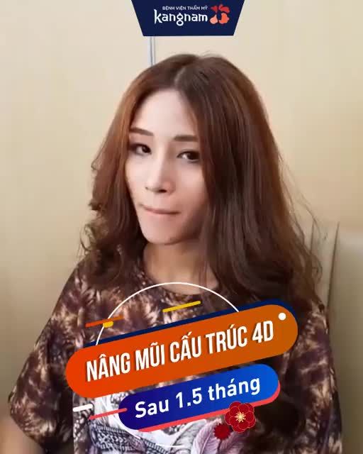MŨI NGẮN - CÁNH MŨI BÈ, đây là nhan sắc sau 1.5 tháng NÂNG MŨI CẤU TRÚC 4D