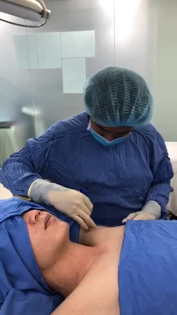 Quá trình chiếu sáng công nghệ Hút tuyến mồ hôi nách Endo Dry