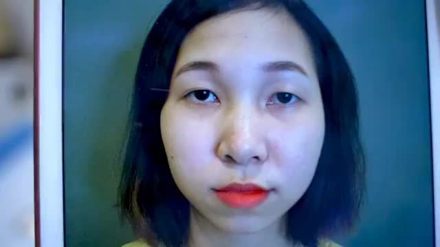 Mời cả nhà cũng ngắm nhìn đôi mắt mới với nếp mí hoàn hảo của bạn khách hàng sau khi sửa mí DEEP TECH20!