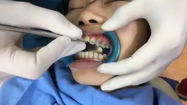 Gắn mắc cài chỉnh nha cho bạn Cúc tại Nha Khoa Thùy Anh.