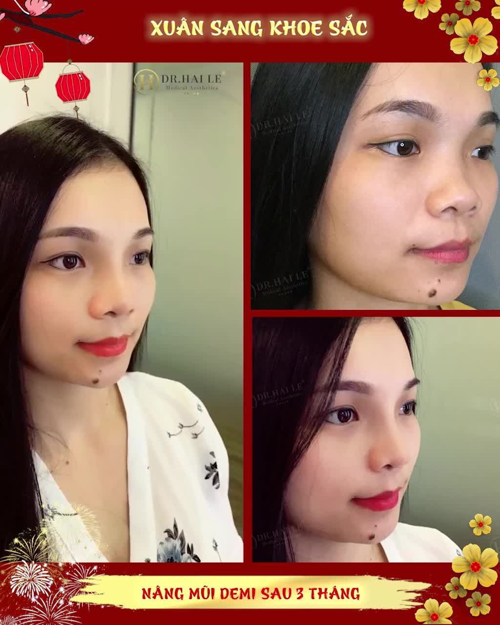 CÓ AI MONG MUỐN XINH ĐẸP NHƯ CÔ ẤY KHÔNG - NÂNG MŨI DEMI 5D TẠI DR.HẢI LÊ BẠN SẼ XINH ĐẸP LAI TÂY SANG CHẢNH