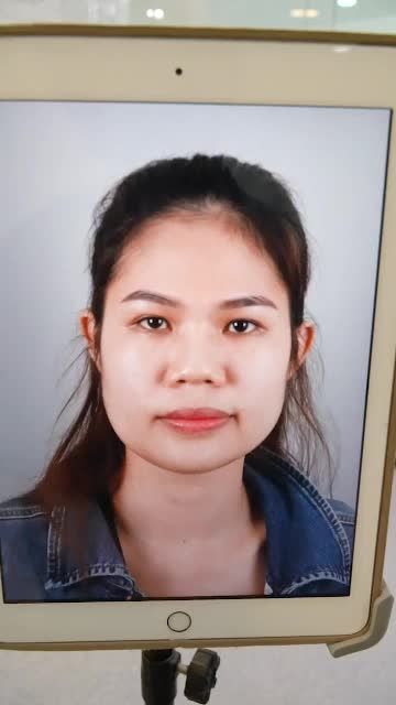 NÂNG MŨI CẤU TRÚC VỪA THỰC HIỆN XONG - MŨI ĐẸP, KHÁCH HÀNG TỈNH TÁO NGAY SAU PT