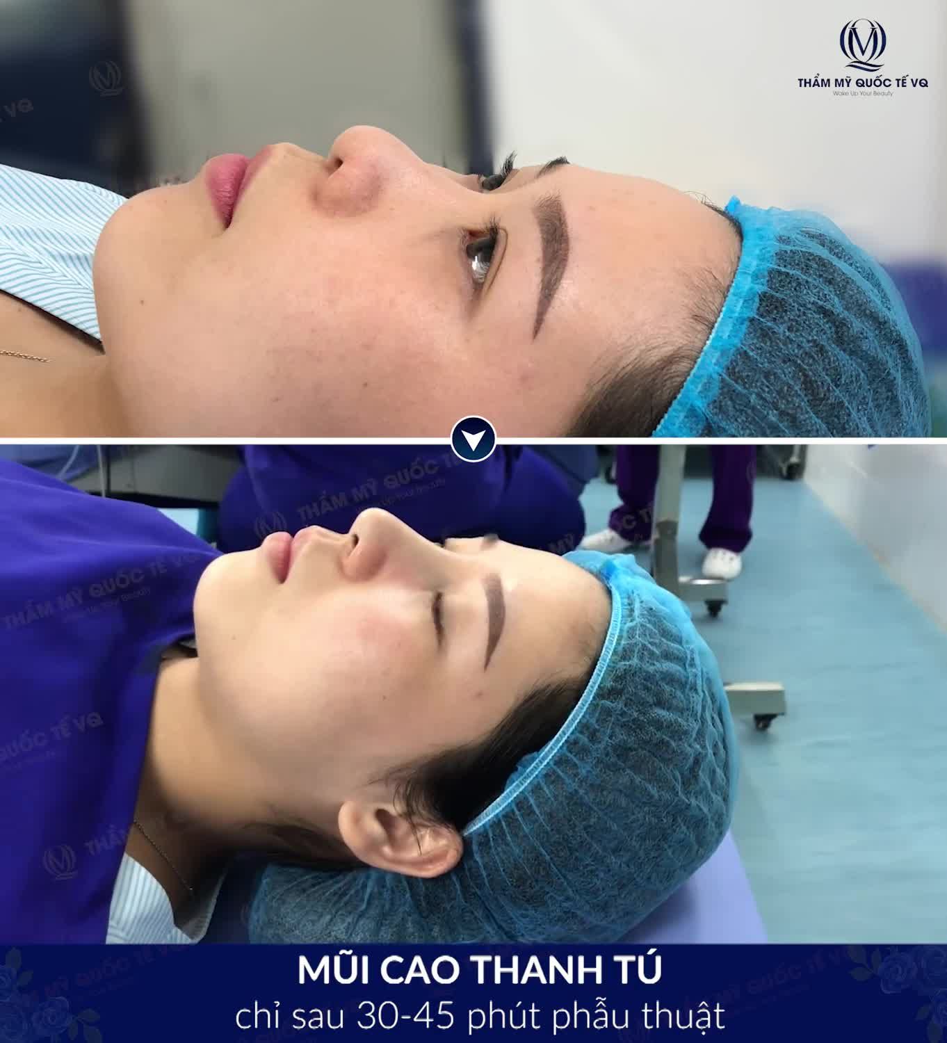 Nâng mũi SOFTLINE - MŨI CAO THANH TÚ