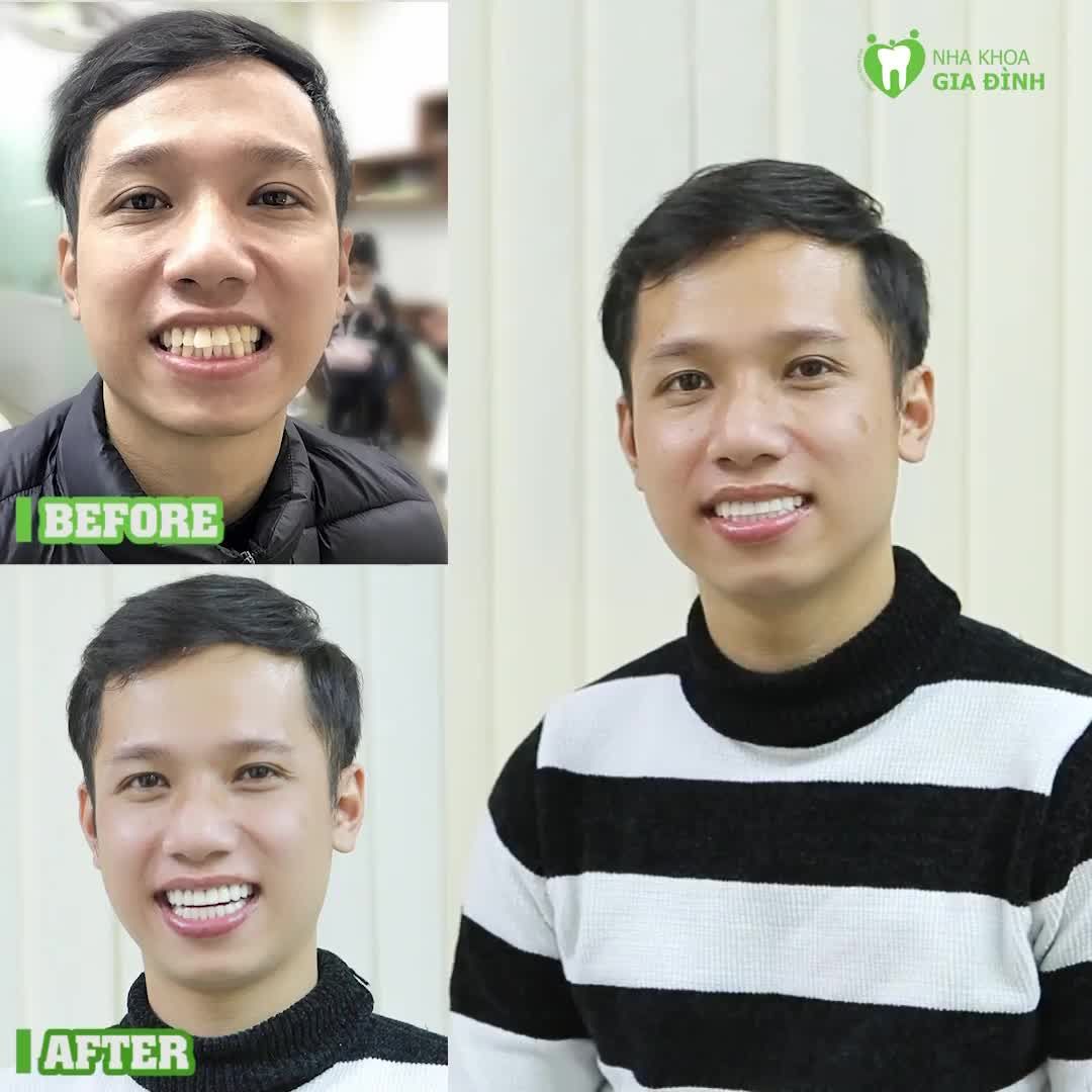 TỰ TIN KHOE NỤ CƯỜI SAU KHI THẨM MỸ RĂNG SỨ