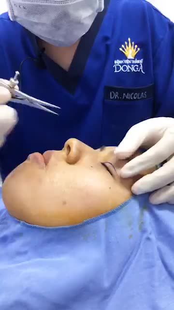 Quá trình đo vẽ khung mắt cho khách hàng trước khi làm phẫu thuật cắt mí trên