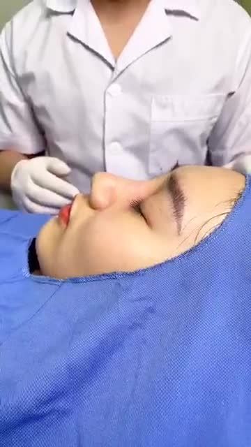 Theo dõi ngay quá trình cắt chỉ sau nâng tại Kangnam