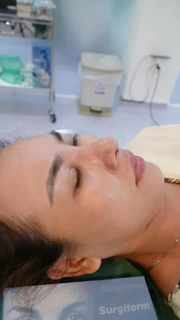 NÂNG MŨI CẤU TRÚC SỬA LẠI VỪA THỰC HIỆN XONG