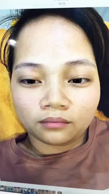 Tái khám phun lông mày sau 1 tháng, phun mí mở tròng.