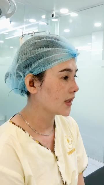 NÂNG MŨI CẤU TRÚC SỬA LẠI VỪA THỰC HIỆN XONG
