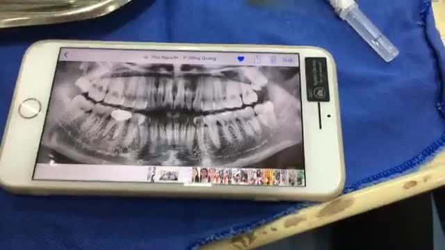 Nhổ răng khôn 28.48 cho bạn Hiền hỗ trợ chỉnh nha.