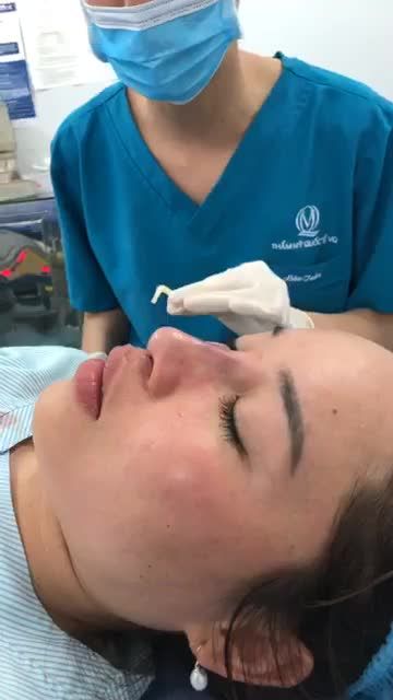 MŨI HỎNG - MŨI LỘ SÓNG, SƯNG ĐỎ, DA ĐẦU MŨI MỎNG sau nâng tại Spa không uy tín được Dr Vũ Quang xử lý thành công