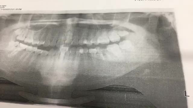 NHỔ RĂNG KHÔN TẠI NHA KHOA THÙY ANH