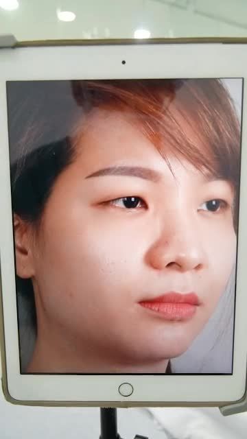 CẬN CẢNH KẾT QUẢ CẮT MÍ MẮT VỪA THỰC HIỆN XONG