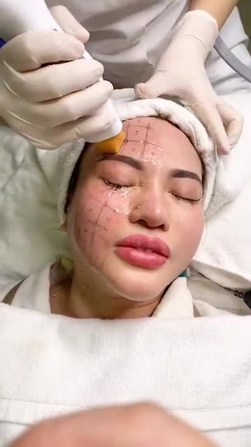 Nữ khách hàng Việt Kiều Đức làm xóa nhăn THERMAGE FLX không phẫu thuật