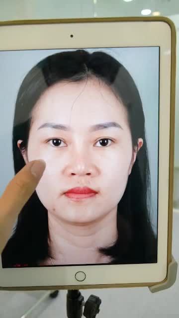 TIẾP TỤC CA NÂNG MŨI CẤU TRÚC VỪA THỰC HIỆN XONG