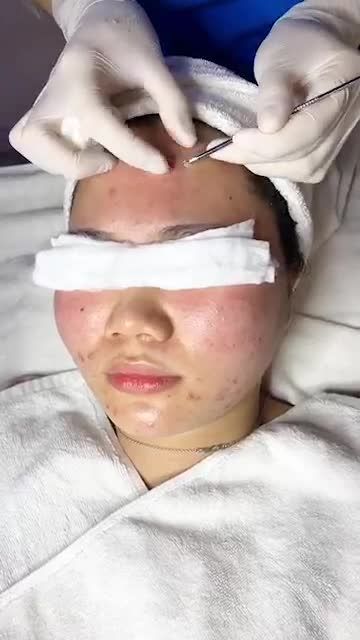 Cản bước MỤN hoành hành đã có NANOSKIN tại Kangnam