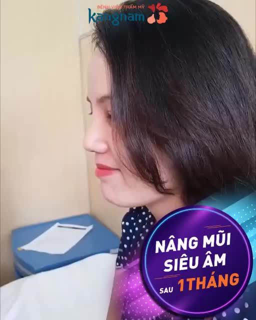 Rạng rỡ hơn nắng Sài Gòn sau 1 tháng Nâng mũi cấu trúc 4D siêu âm