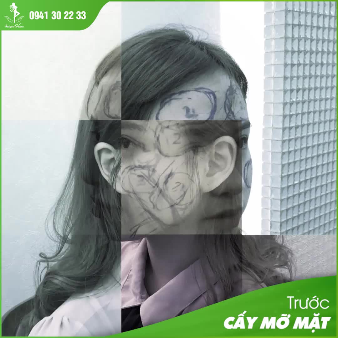 TRẺ HOÁ TOÀN DIỆN GƯƠNG MẶT BẰNG MÔ MỠ TỰ THÂN