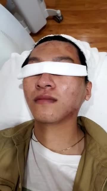 Chiếu đèn TRỊ MỤN NANO SKIN - Khuyến mại 0Đ