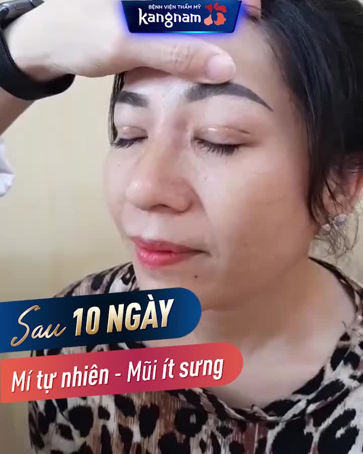 U50 Lột Xác tự tin sau 10 Ngày CẮT MÍ + NÂNG MŨI