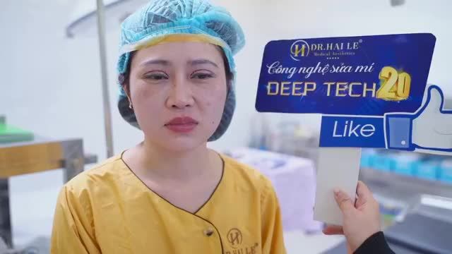 Đổi mí xấu hỏng, lấy mí đẹp sang chỉ sau 30 phút với công nghệ DEEP TECH20 độc quyền tại DR.HẢI LÊ!