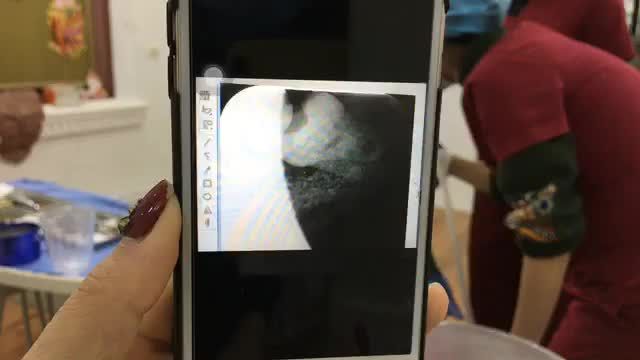 Nhổ răng khôn mọc lệch 90 độ cho chị Hà