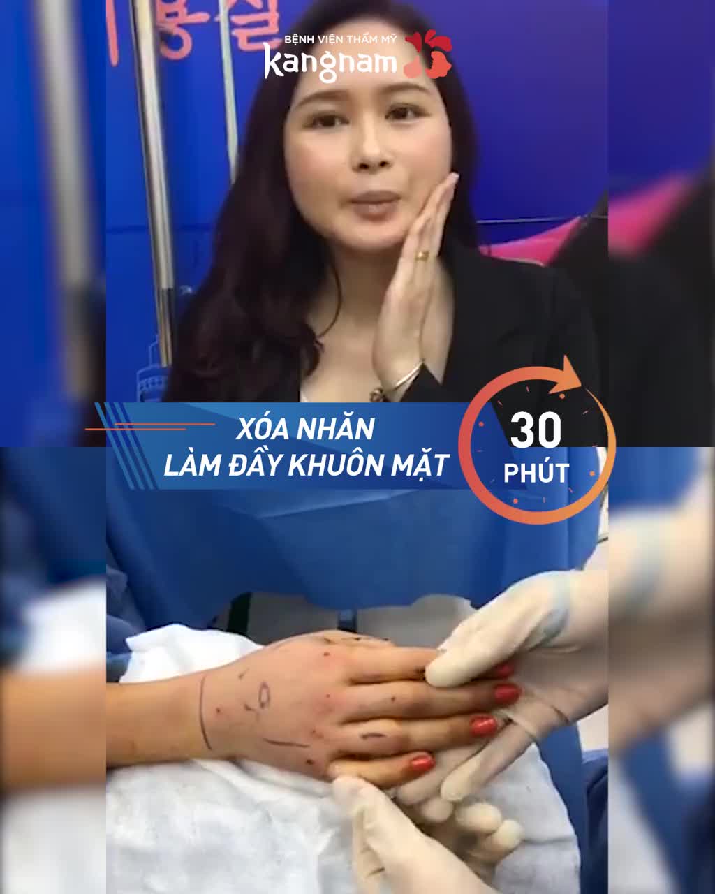 Mặt gầy, da nhăn nheo, má hóp - Đã có Cấy mỡ Nano Fat