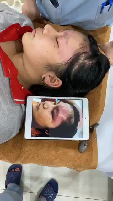 Cùng Dr Hoàng Tuấn trên chặng đường loại bỏ u máu với công nghệ laser Vbeam!