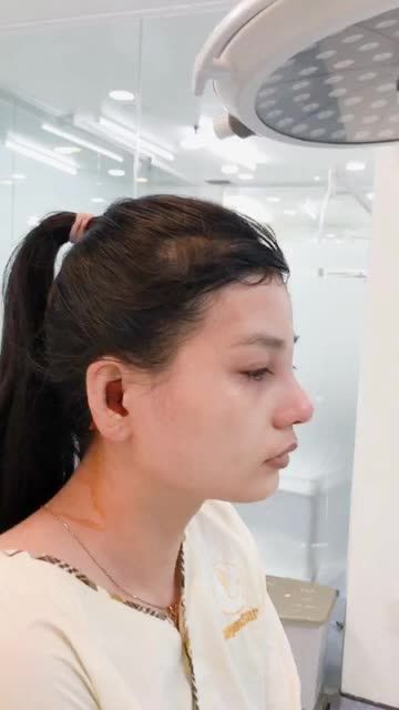 KẾT QUẢ NÂNG MŨI CẤU TRÚC SỤN SURGIFORM TỪ MỸ VỪA THỰC HIỆN XONG