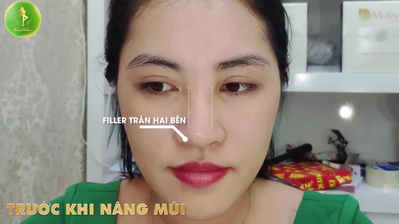 MŨI TIÊM FILLER BỊ HỎNG - ĐẾN BÁC SĨ HUY KHẮC PHỤC NGAY!