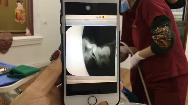 Nhổ răng khôn mọc ngầm cho bạn Phương.