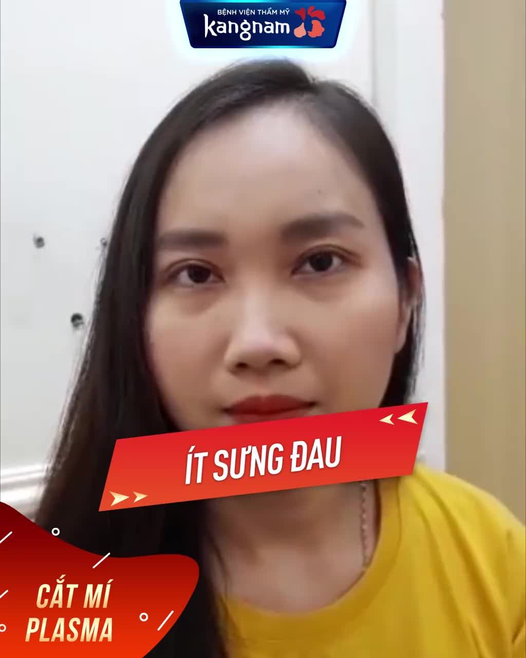 Khách hàng 1 MÍ  Lột Xác xuất sắc sau CẮT MÍ PLASMA