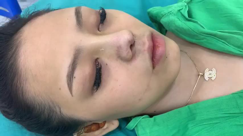 DÁNG MŨI TỰ NHIÊN - GÓC NGHIÊNG THẦN THÁNH