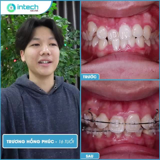 Feedback “cực chất” của Trương Hồng Phúc- Khách hàng niềng răng 6 tháng tại Nha khoa Lạc Việt Intech.