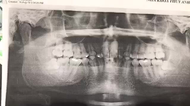 Nhổ răng khôn tại Nha Khoa Thuỳ Anh.