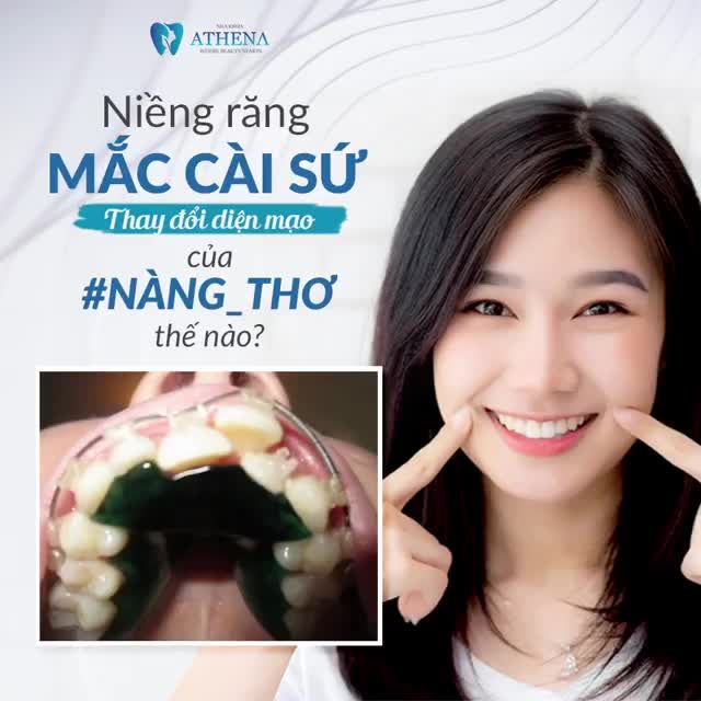Niềng răng mắc cài sứ thay đổi diện mạo của NÀNG THƠ thế nào?