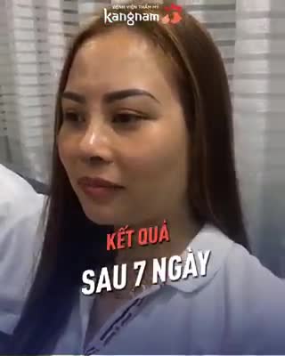 Nửa vòng trái đất bay về Việt Nam NÂNG MŨI CẤU TRÚC 4D tại Kangnam, khách hàng vô cùng hài lòng!