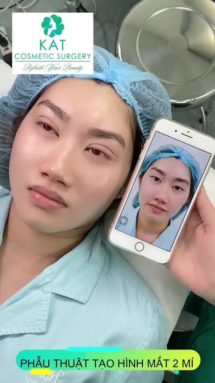 PHẪU THUẬT MÍ MẮT với khả năng “giải cứu” nhiều khuyết điểm cho vùng mắt như: mắt 1 mí, mí lót, sụp mí, tình trạng da chùng, mỡ thừa...nên ngày càng được nhiều khách hàng lựa chọn để nhanh chóng sở hữu được đôi mắt 2 mí cuốn hút người đối diện ?