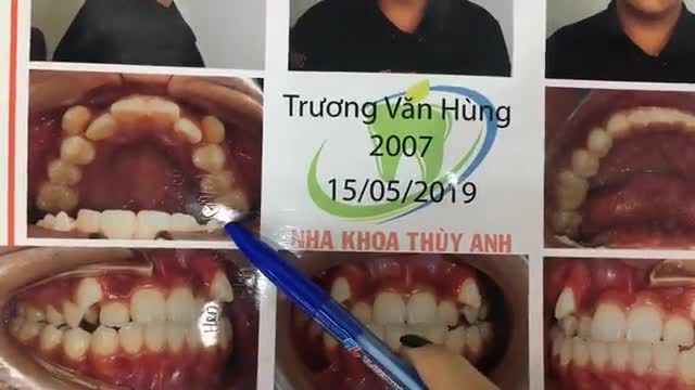 Gắn mắc cài cho bạn Hùng tại Nha Khoa Thuỳ Anh.