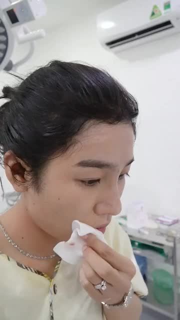 NÂNG MŨI CẤU TRÚC SỬA LẠI VỪA THỰC HIỆN XONG - MŨI ĐẸP HÀI HÒA