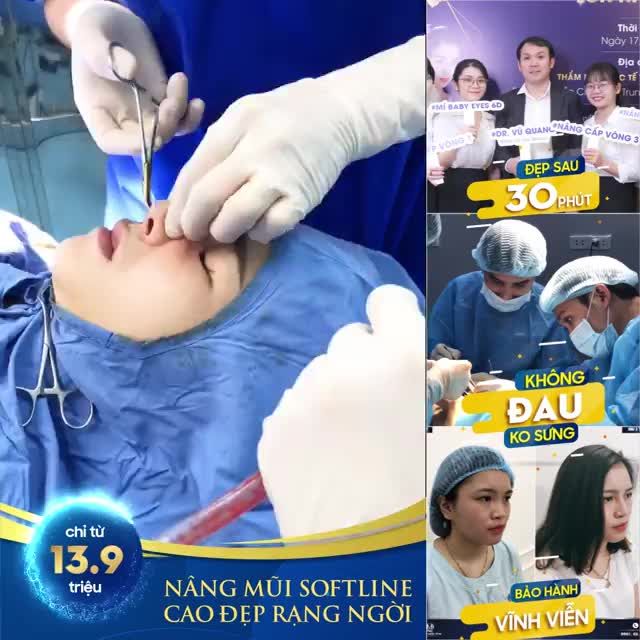 NÂNG MŨI SOFTLINE - MŨI CAO SANG - ĐẸP RẠNG NGỜI