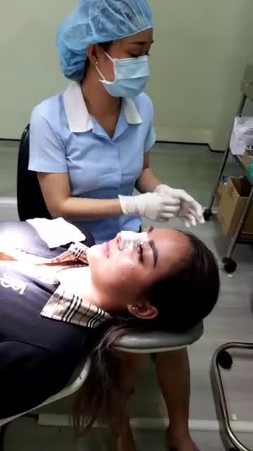 NÂNG MŨI SỤN SƯỜN, SURGIFORM CẢI THIỆN DÁNG MŨI THẤP TÁI KHÁM SAU 10 NGÀY