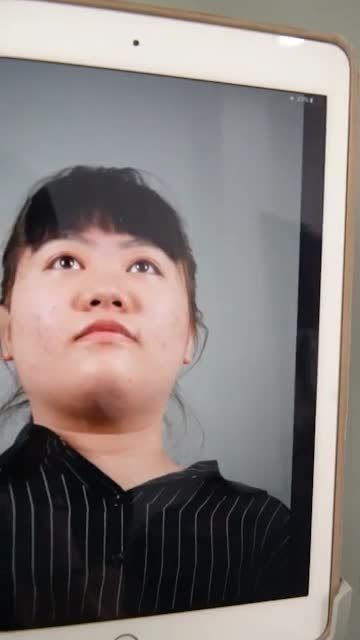 MŨI CẤU TRÚC SAU 10 NGÀY THAY ĐỔI NHƯ THẾ NÀO ?