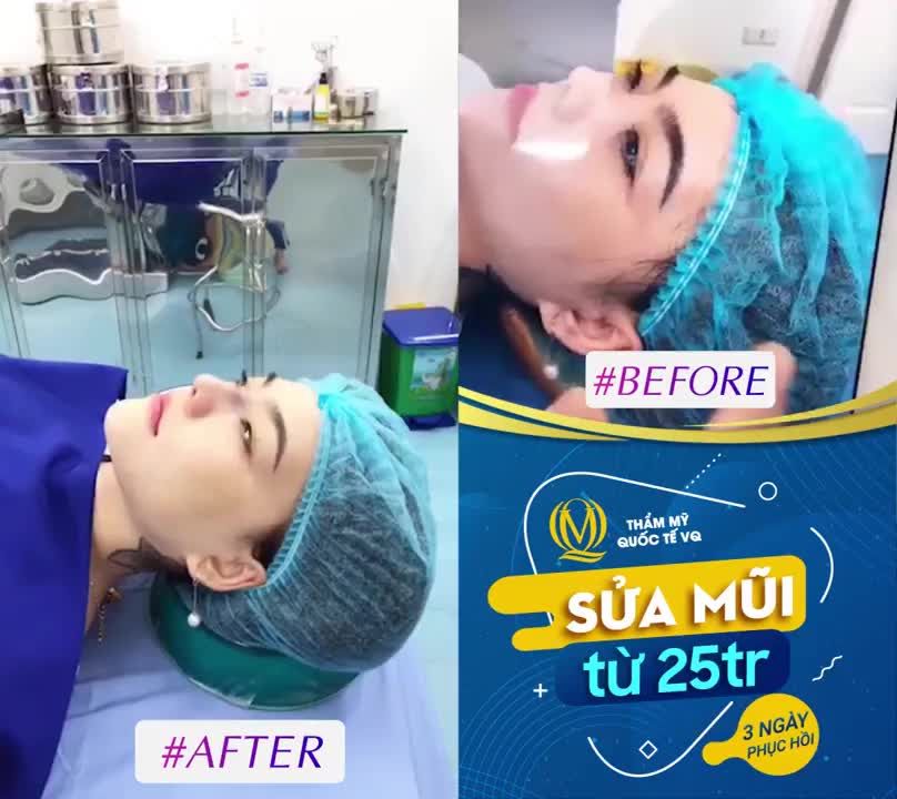 MŨI HỎNG, MŨI KHÓ ĐÃ CÓ Dr Vũ Quang