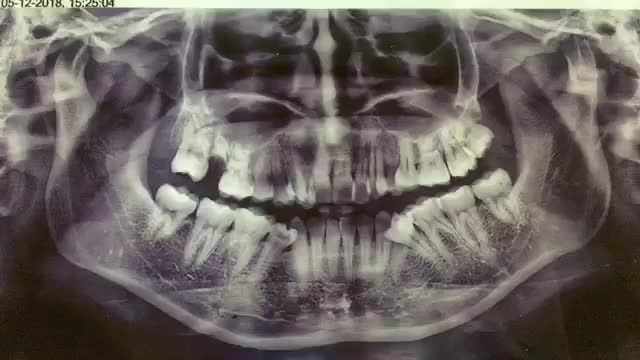 Nhổ răng khôn lệch má phục vụ chỉnh nha cho chị Xuân tại Nha Khoa Thuỳ Anh.